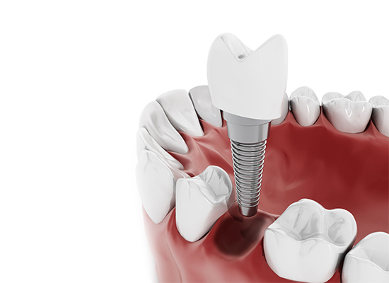 Dental Implants & Treatment in Lalor