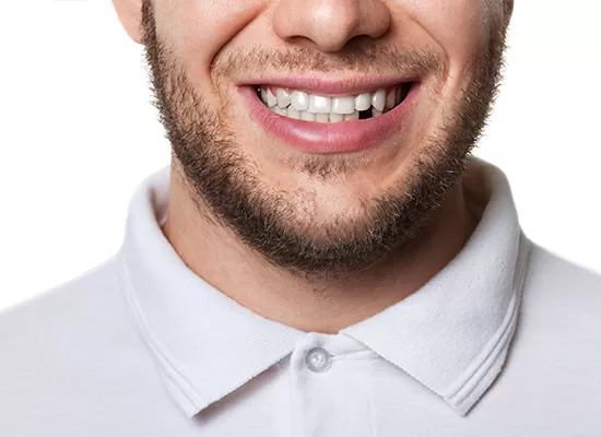 Missing Teeth Treatment