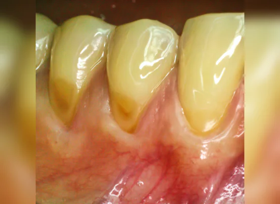 Stained and Discolored/Yellowed Teeth